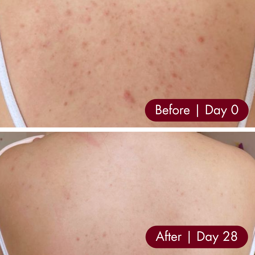 28-Day Clear Skin