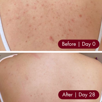 28-Day Clear Skin